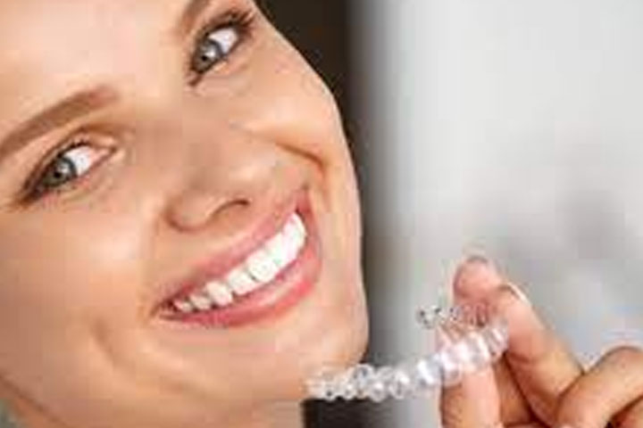 Alineadores dentales